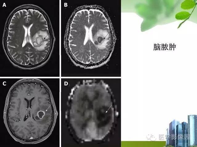 【PPT】磁共振ASL灌注成像在神经系统的应用