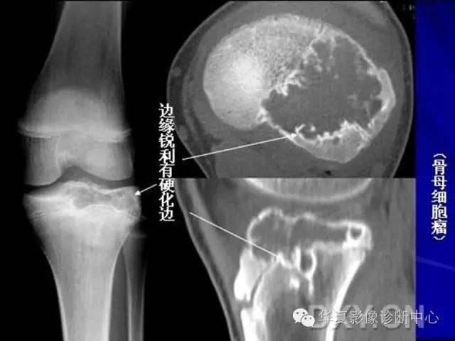 【PPT】骨肿瘤诊断分析的基本要素