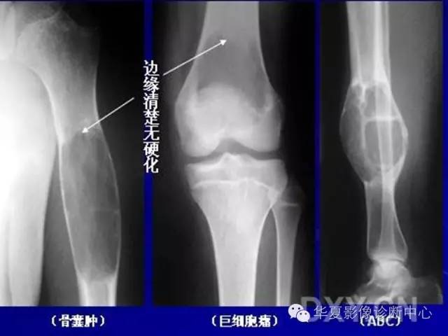 【PPT】骨肿瘤诊断分析的基本要素