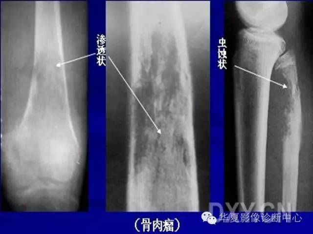 【PPT】骨肿瘤诊断分析的基本要素