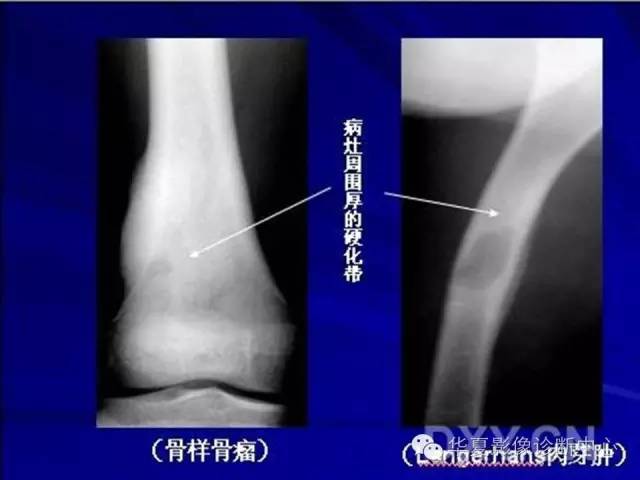 【PPT】骨肿瘤诊断分析的基本要素