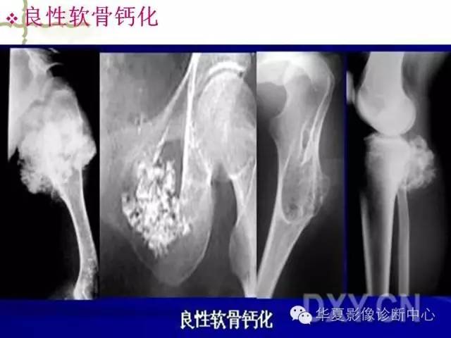 【PPT】骨肿瘤诊断分析的基本要素