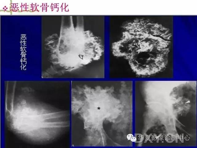 【PPT】骨肿瘤诊断分析的基本要素