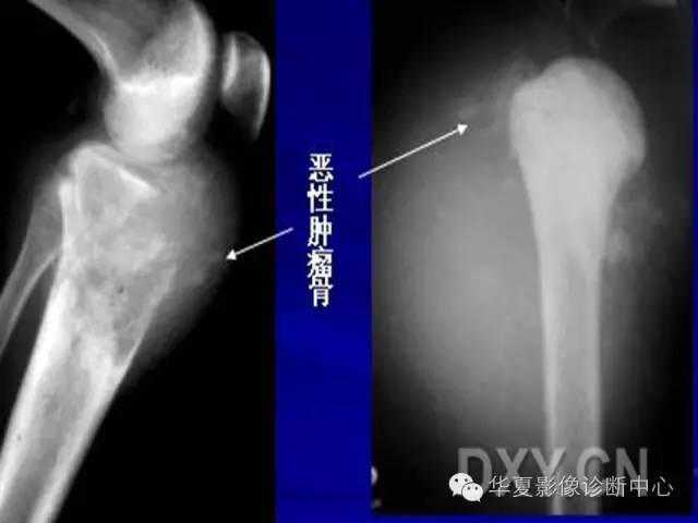 【PPT】骨肿瘤诊断分析的基本要素