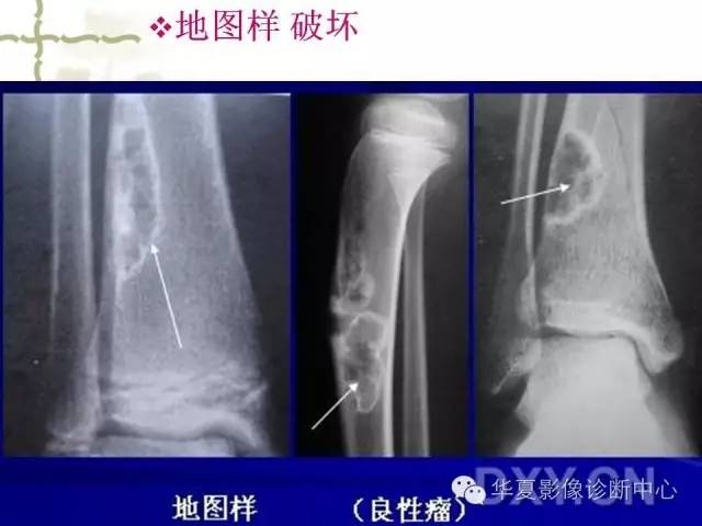 【PPT】骨肿瘤诊断分析的基本要素