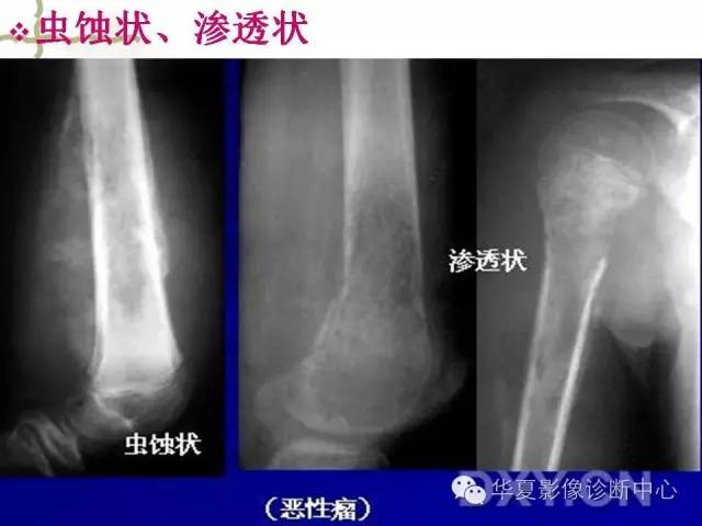 【PPT】骨肿瘤诊断分析的基本要素