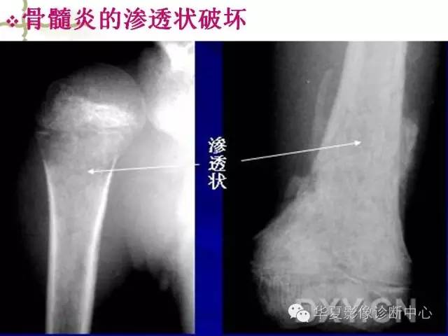 【PPT】骨肿瘤诊断分析的基本要素