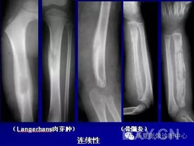 【PPT】骨肿瘤诊断分析的基本要素