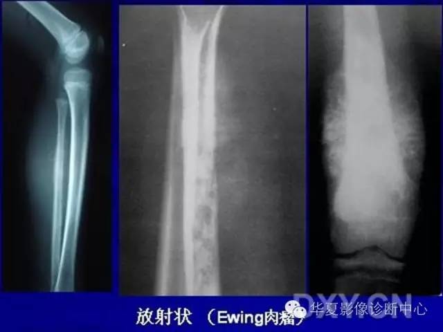【PPT】骨肿瘤诊断分析的基本要素