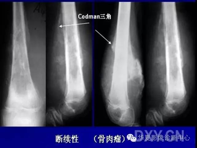 【PPT】骨肿瘤诊断分析的基本要素