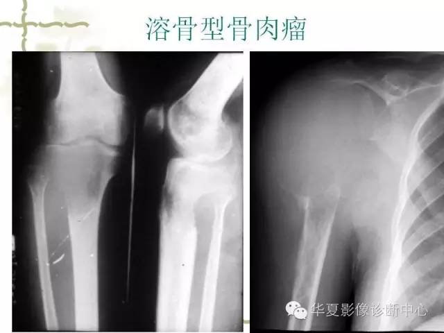 【PPT】骨肿瘤诊断分析的基本要素