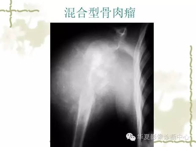 【PPT】骨肿瘤诊断分析的基本要素