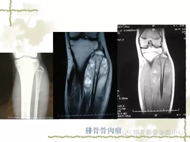 【PPT】骨肿瘤诊断分析的基本要素