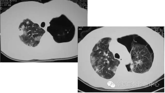 【病例】肺吸虫病1例CT影像表现