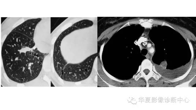【病例】肺吸虫病1例CT影像表现