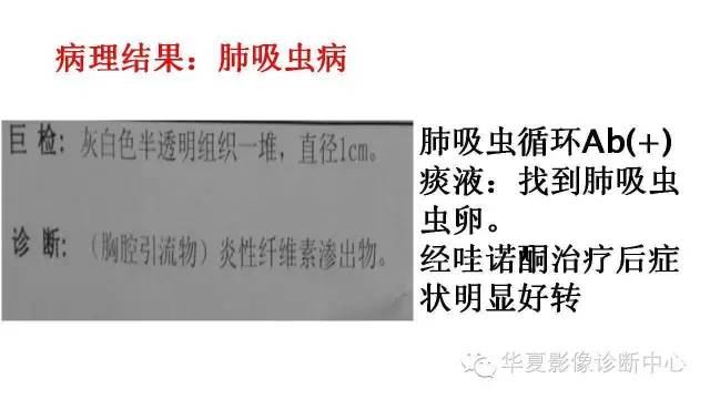 【病例】肺吸虫病1例CT影像表现