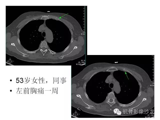 【PPT】重视应力性骨损伤的诊断
