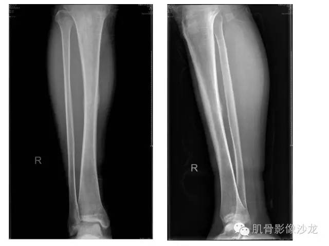 【PPT】重视应力性骨损伤的诊断