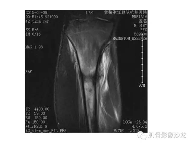 【PPT】重视应力性骨损伤的诊断