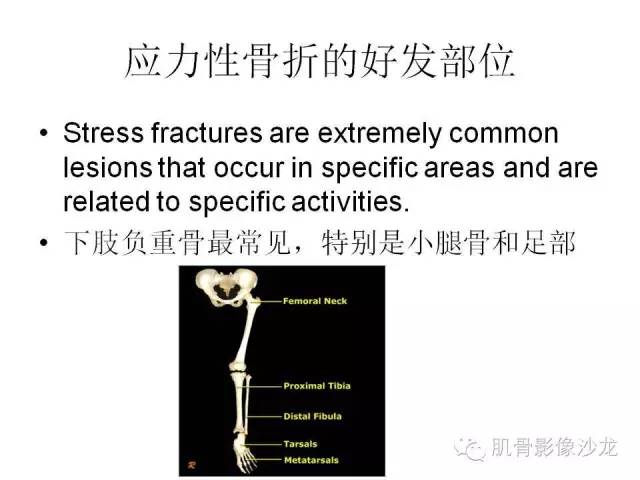 【PPT】重视应力性骨损伤的诊断