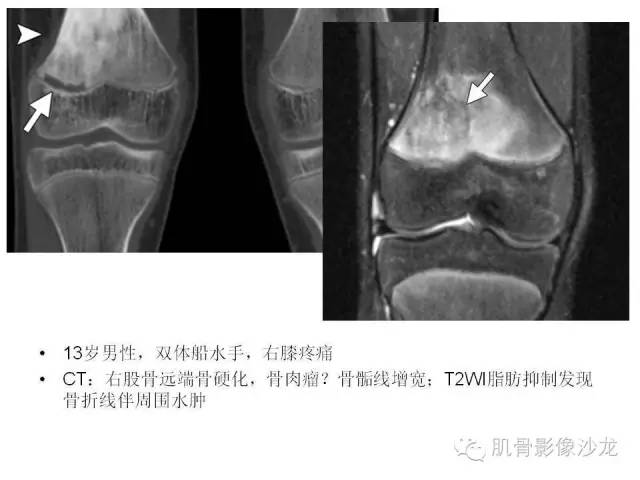 【PPT】重视应力性骨损伤的诊断