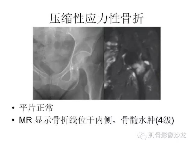 【PPT】重视应力性骨损伤的诊断