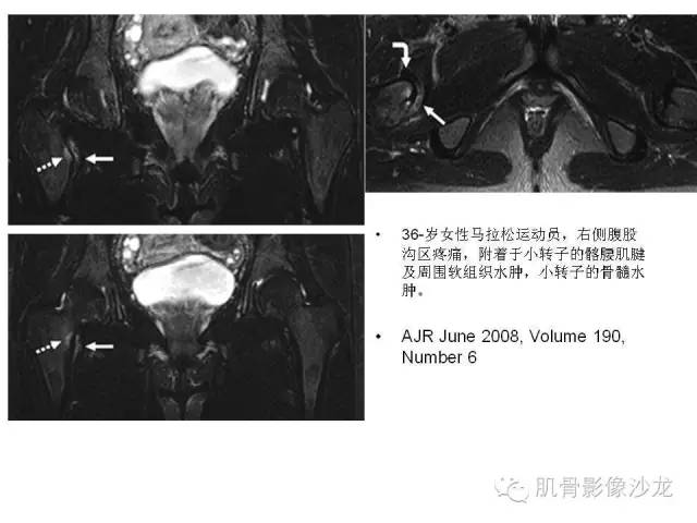 【PPT】重视应力性骨损伤的诊断