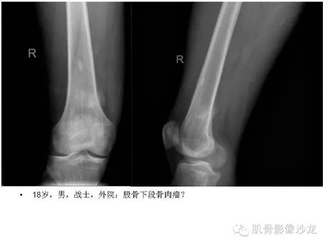 【PPT】重视应力性骨损伤的诊断