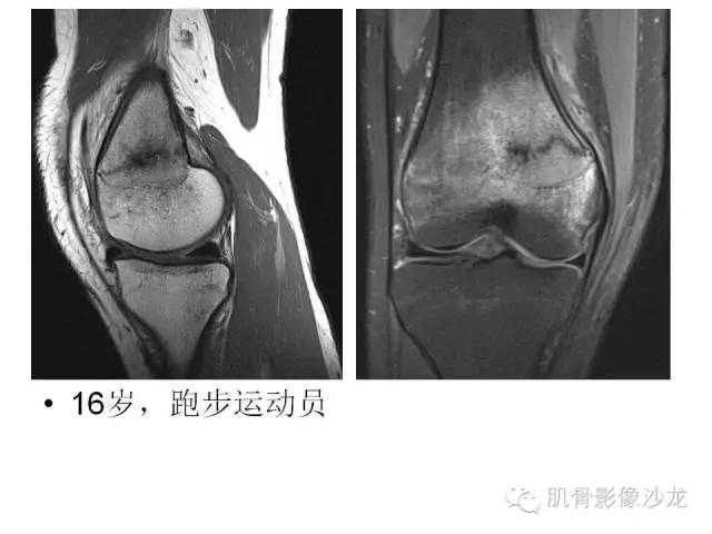 【PPT】重视应力性骨损伤的诊断