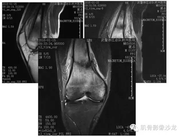 【PPT】重视应力性骨损伤的诊断