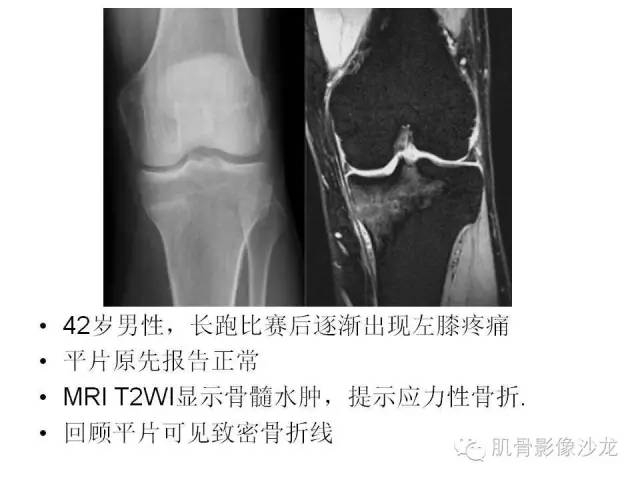 【PPT】重视应力性骨损伤的诊断