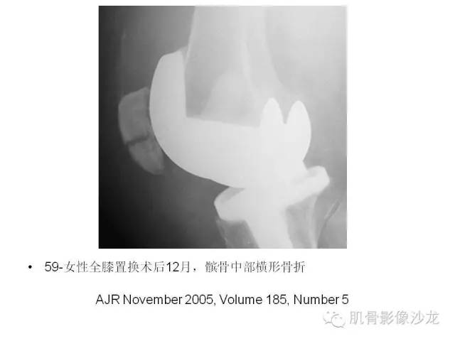 【PPT】重视应力性骨损伤的诊断