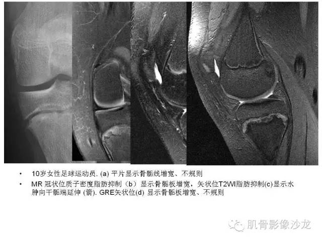 【PPT】重视应力性骨损伤的诊断
