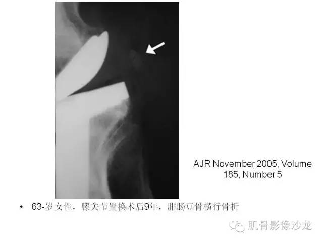 【PPT】重视应力性骨损伤的诊断