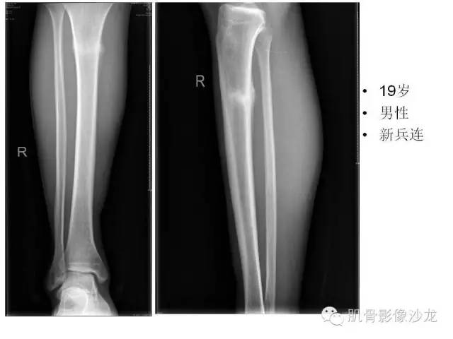 【PPT】重视应力性骨损伤的诊断