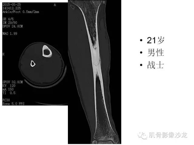 【PPT】重视应力性骨损伤的诊断