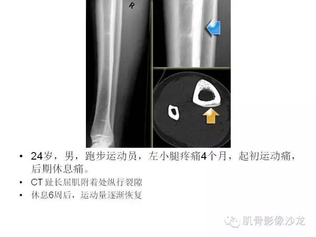 【PPT】重视应力性骨损伤的诊断