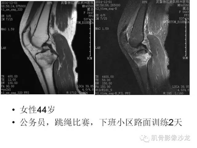【PPT】重视应力性骨损伤的诊断
