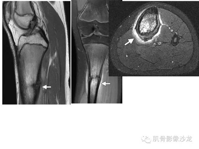 【PPT】重视应力性骨损伤的诊断