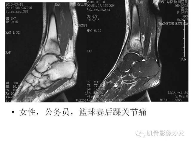 【PPT】重视应力性骨损伤的诊断