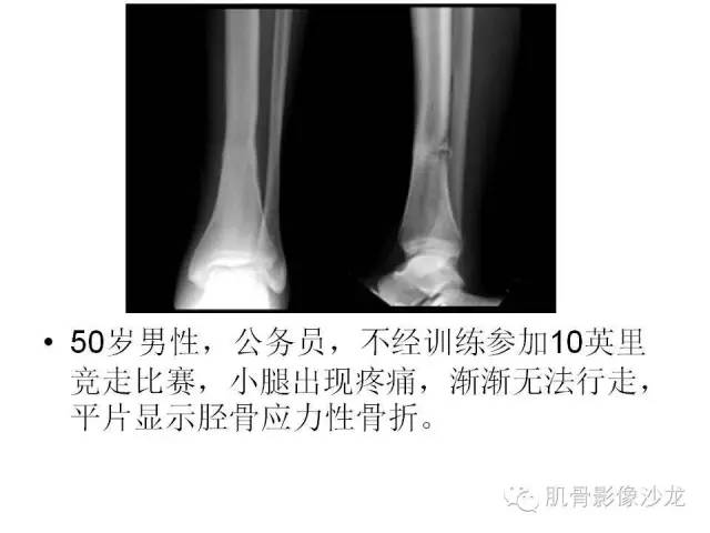 【PPT】重视应力性骨损伤的诊断