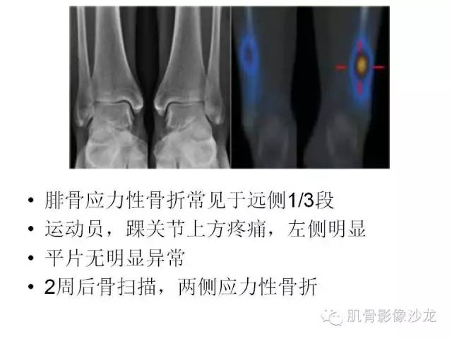 【PPT】重视应力性骨损伤的诊断