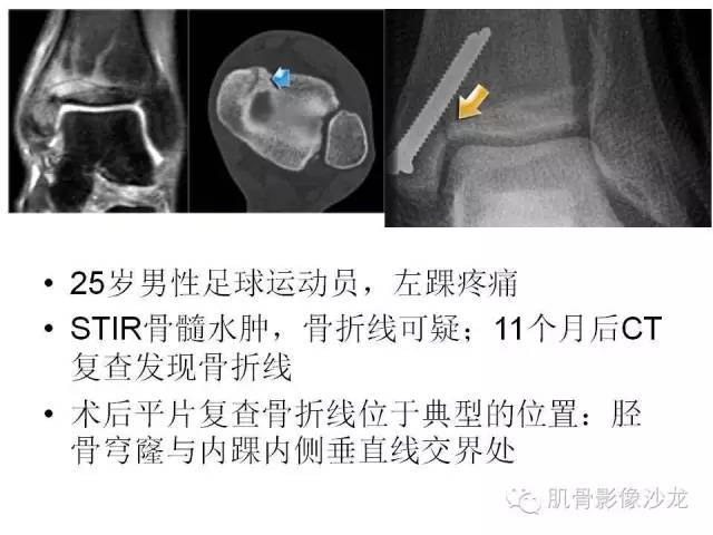 【PPT】重视应力性骨损伤的诊断