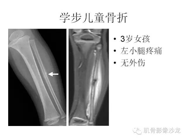 【PPT】重视应力性骨损伤的诊断