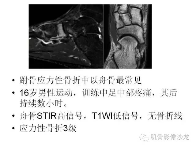 【PPT】重视应力性骨损伤的诊断