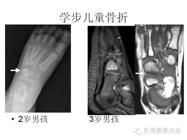 【PPT】重视应力性骨损伤的诊断