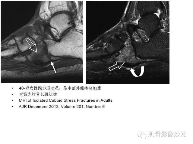 【PPT】重视应力性骨损伤的诊断