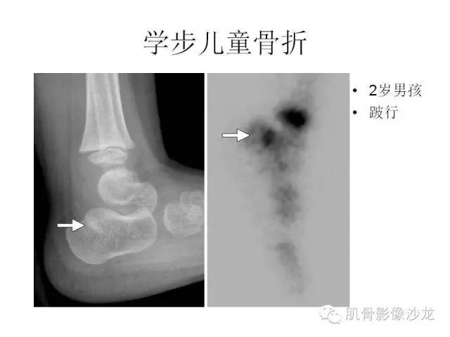 【PPT】重视应力性骨损伤的诊断