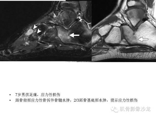 【PPT】重视应力性骨损伤的诊断