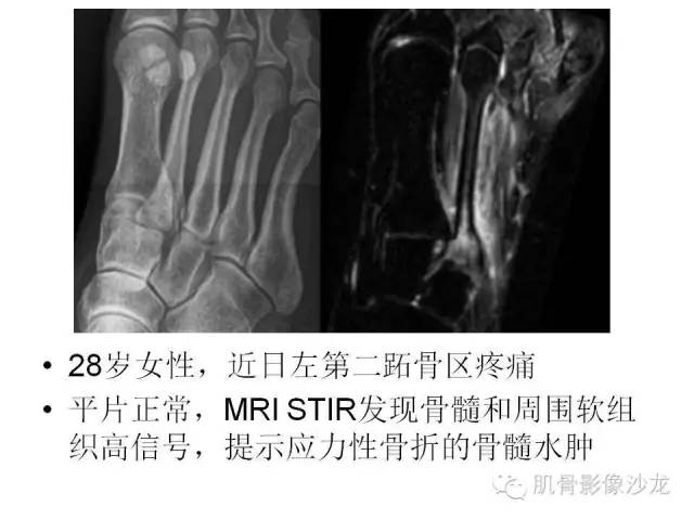 【PPT】重视应力性骨损伤的诊断